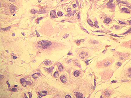 Clinically Amelanotic Malignant Melanoma